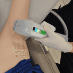 미라드라이 프레쉬, 시술 과정 정리 (ft. 겨드랑이 다한증, 액취증 치료 및 제모)