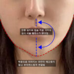 턱끝필러 부작용, 제거 후 재시술을 진행한 이야기